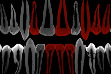 Dentes de adolescente de 1,8 milhão de anos mostram pistas de evolução do crescimento humano